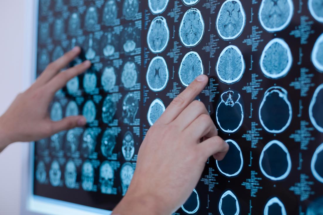 close up of doctor's hands pointing to brain xrays