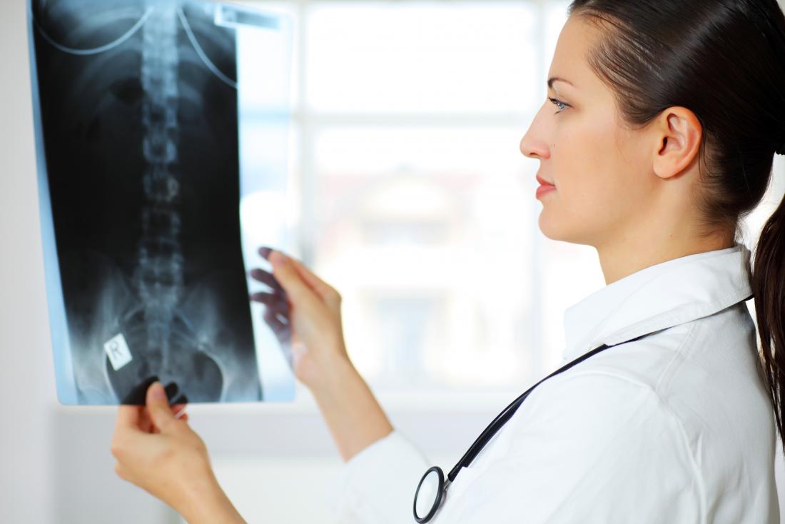 Doctor looking at an X-Ray of a spine