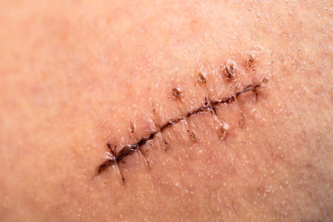 dissolvable stitches