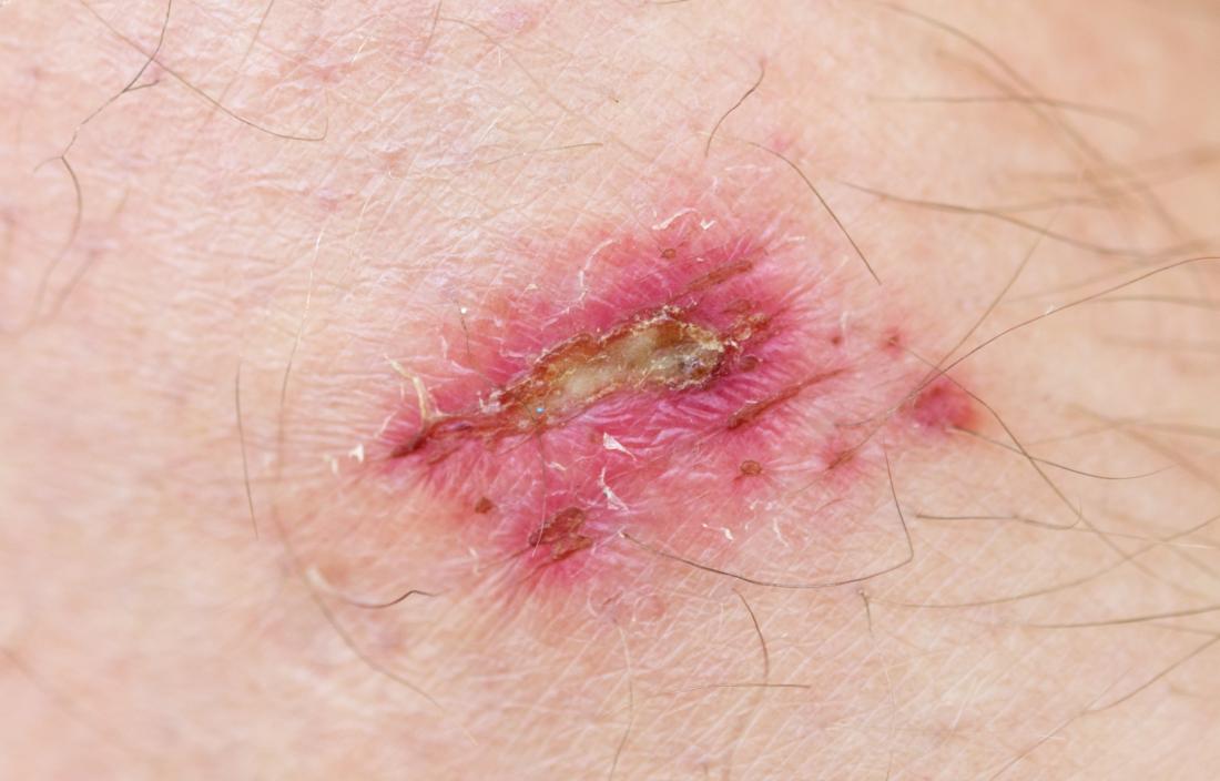 dissolvable stitches can cause infection