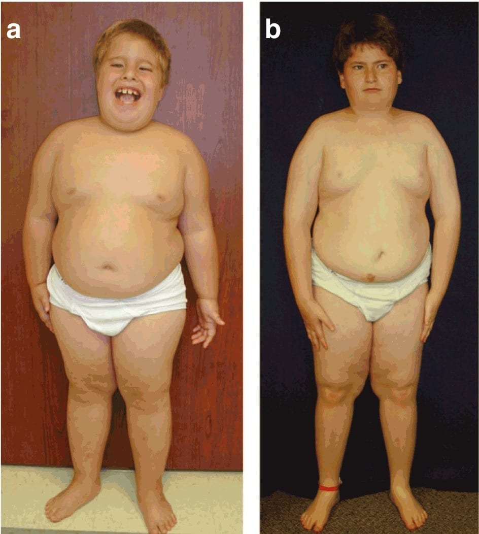 Growth hormone deficient children