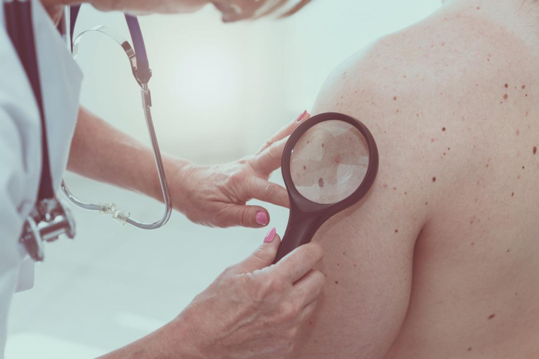 Warning signs of cancer moles