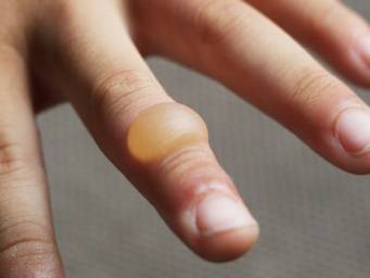 How to recognize and treat a burn blister
