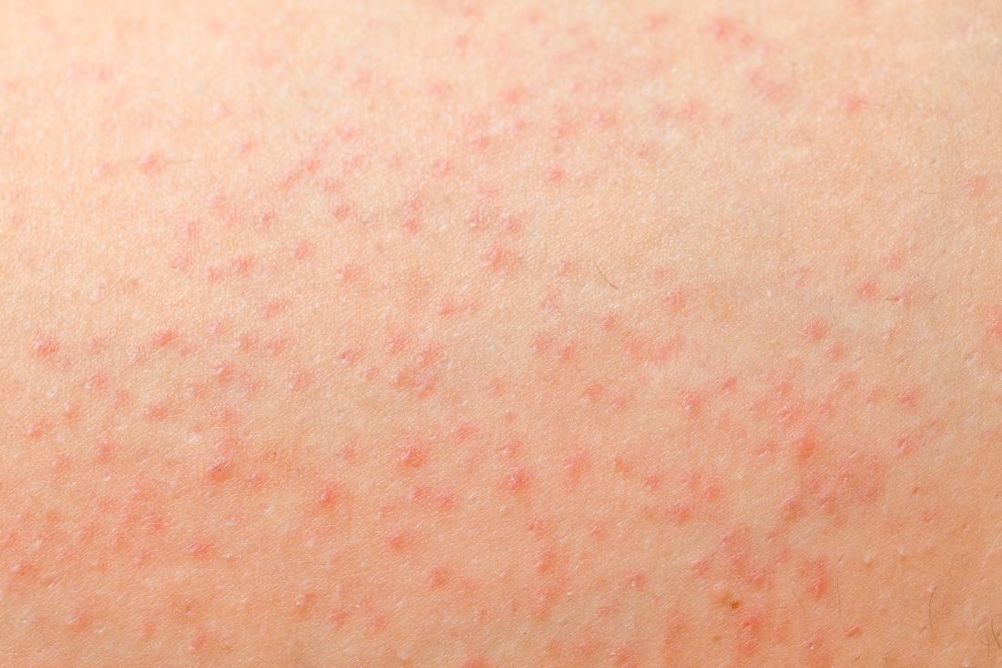 close up of folliculitis