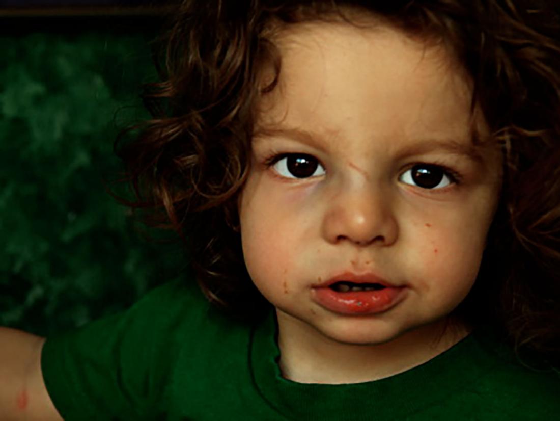 Child with broken nose . Image credit: Marco Anto<em></em>nio Torres, 2006.