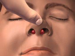 All you need to know a<em></em>bout septal hematoma
