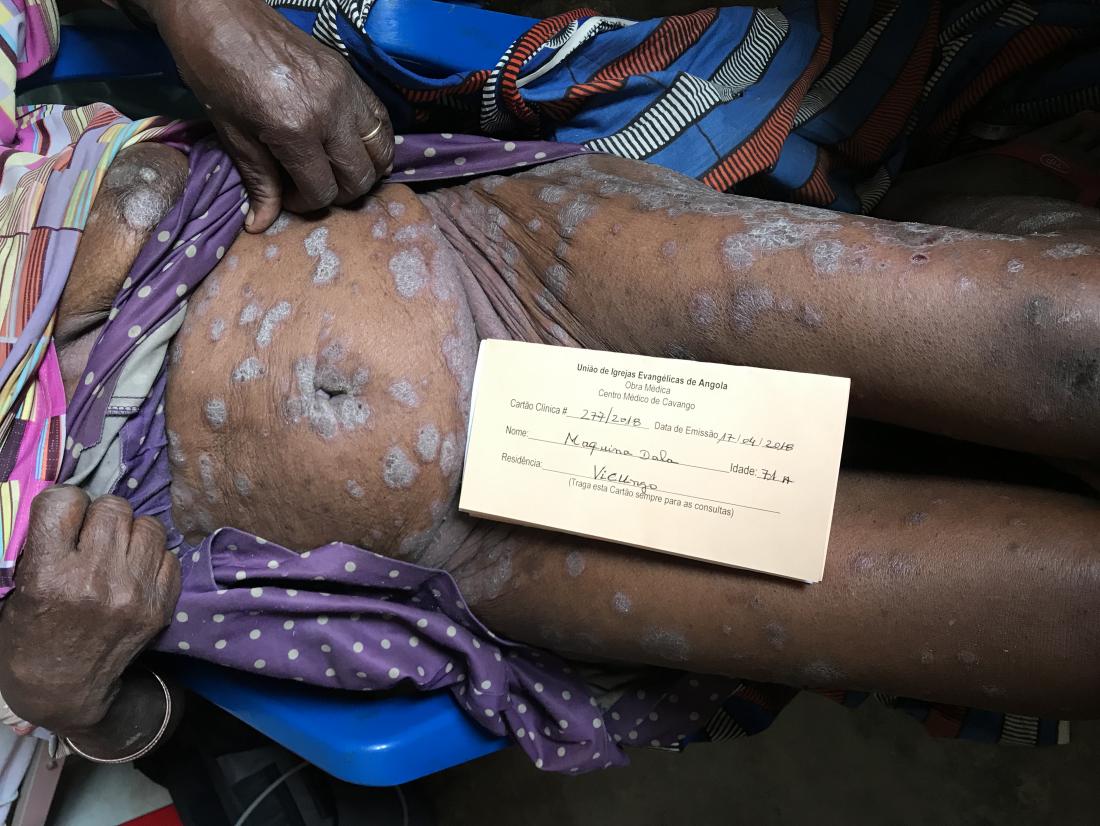Psoriasis on black skin. Image credit: Tim Kubacki, 2018.