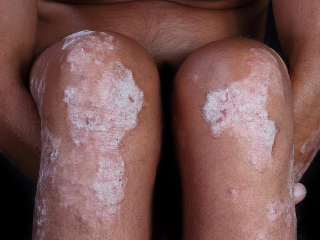 Psoriasis on knees of person with brown or black skin.