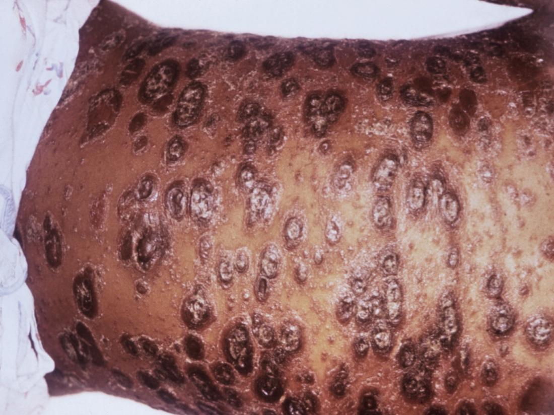 Psoriasis on black skin. Image credit: CDC/ Gavin Hart, 1977.