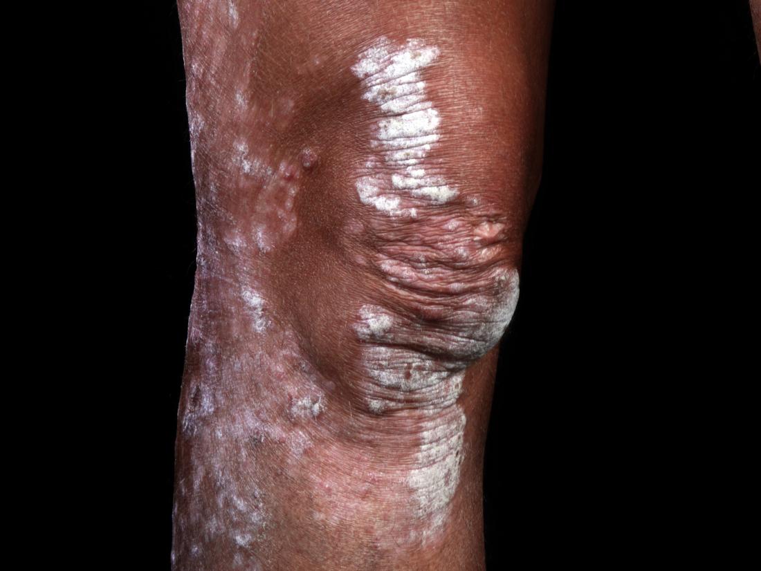 Psoriasis on knee of person with black skin.