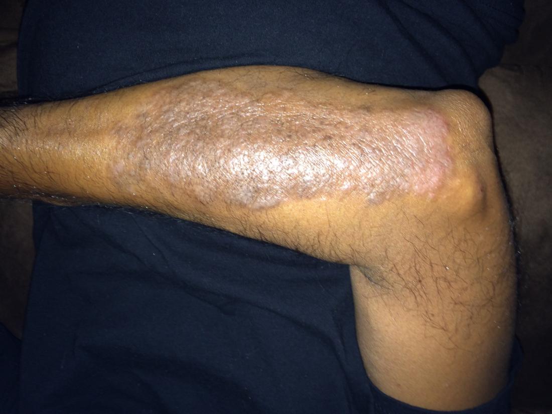 Psoriasis on arm of person with brown skin.