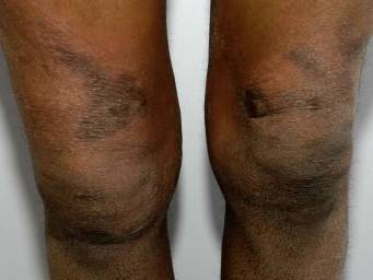 Eczema on black skin: What to know